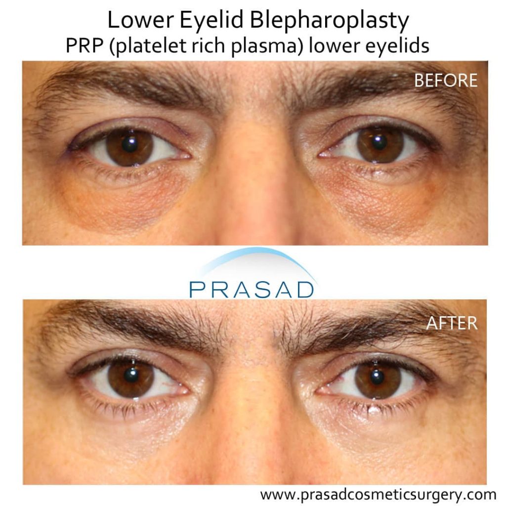 eye bag surgery before and after with PRP for under eyes