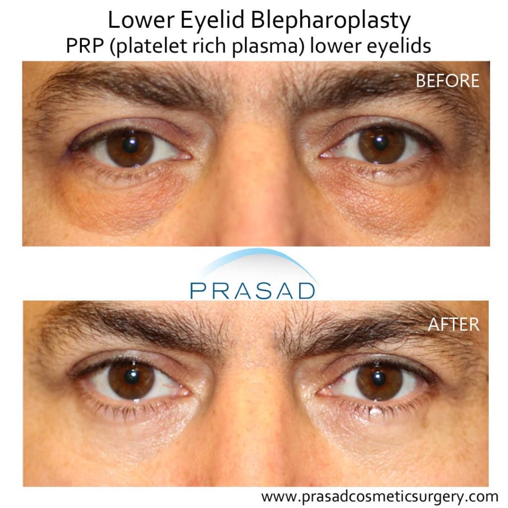 Benefits of PRP Injection Under Eyes Dr. Prasad New York