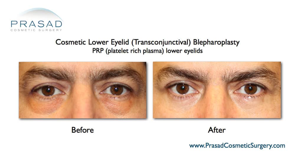 eye bag surgery with PRP for under eyes before and after