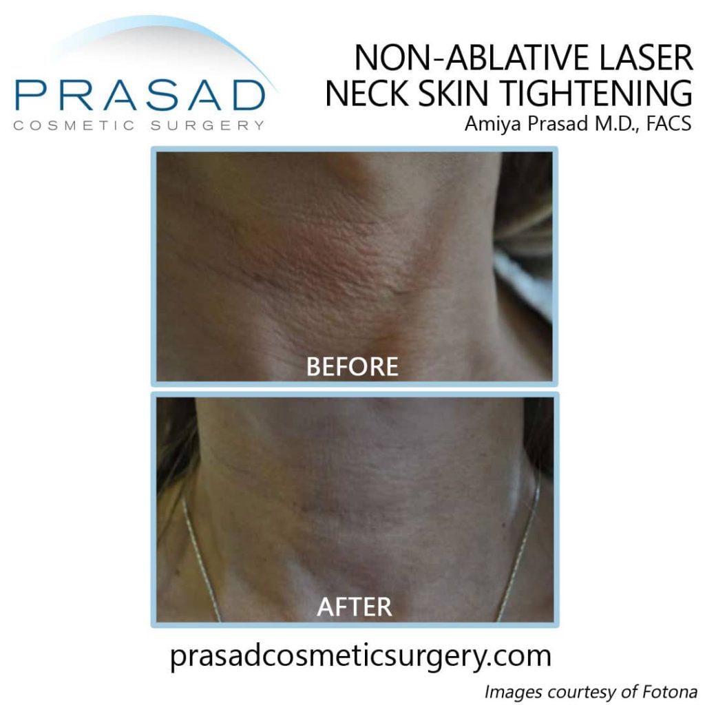 non-surgical neck lift before and after complete recovery
