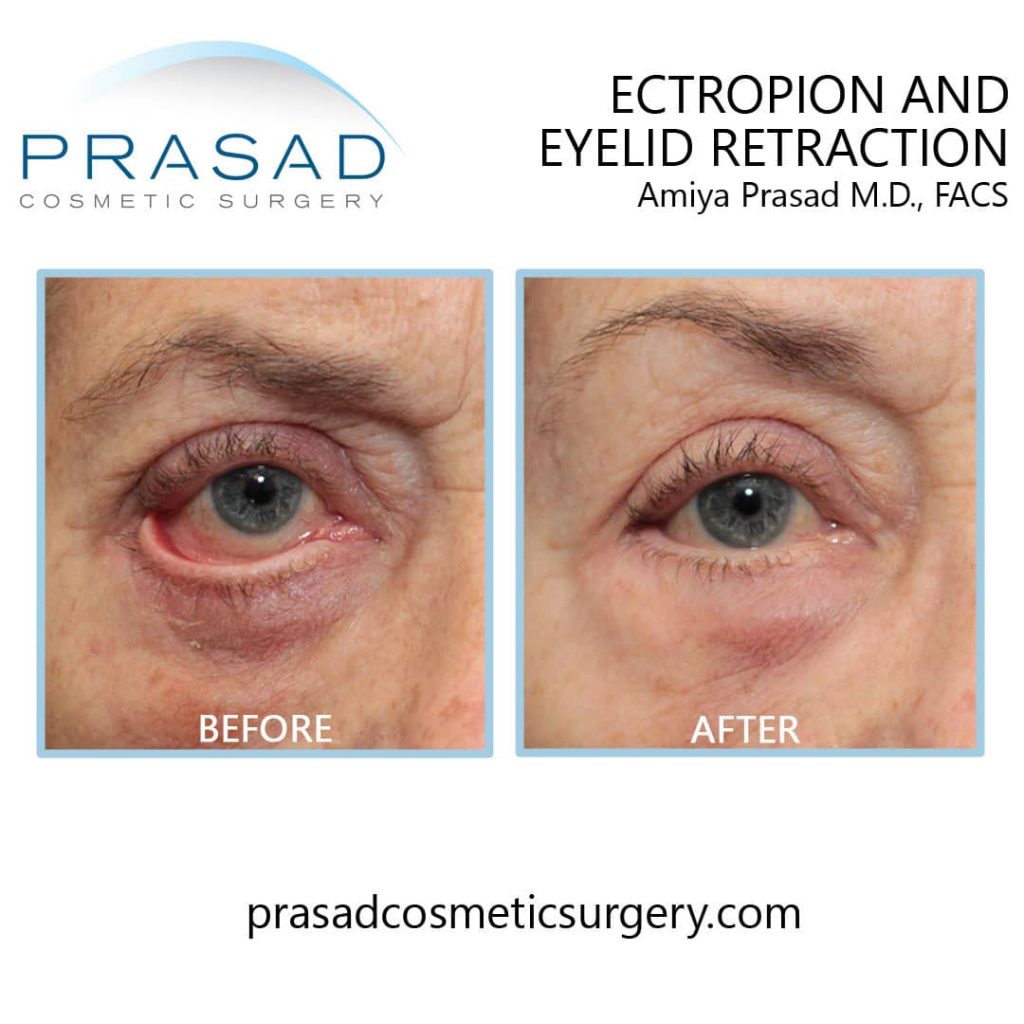 Can Eye Bag Surgery Go Wrong Dr. Prasad Blog