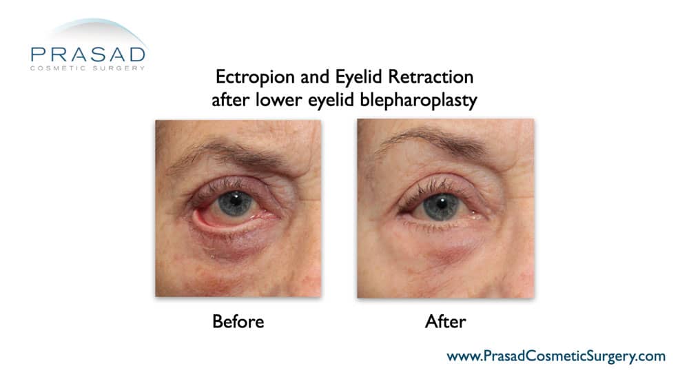 revision of lower eyelid blepharoplasty gone wrong before and after