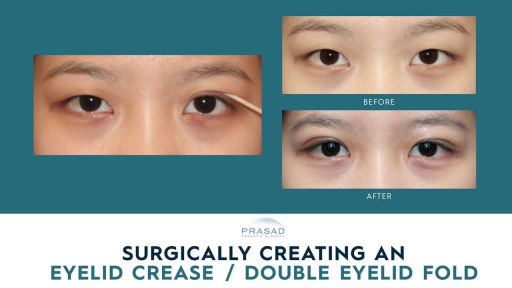 how eyelid crease is created surgically