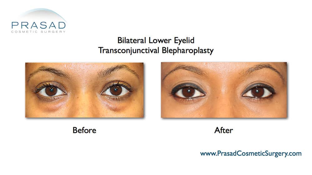 Lower blepharoplasty before and after young woman