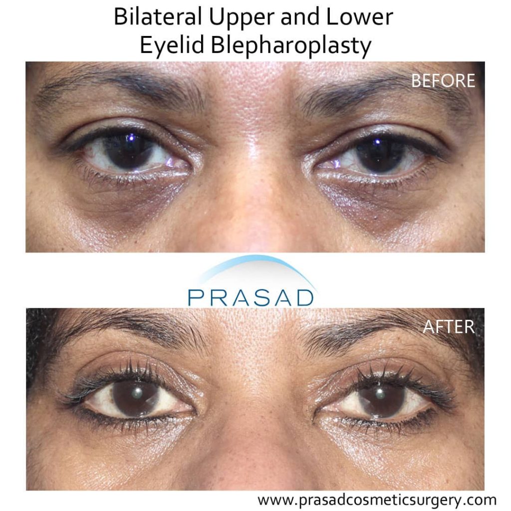upper and lower blepharoplasty before and after photo. procedure performed at Prasad Cosmetic Surgery Manhattan NYC