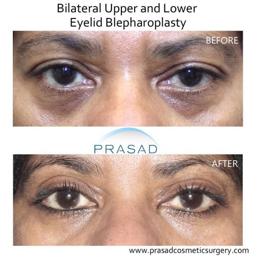 Minimizing Eyelid Surgery Scars in Darker Skin & Keloid-Prone Skin