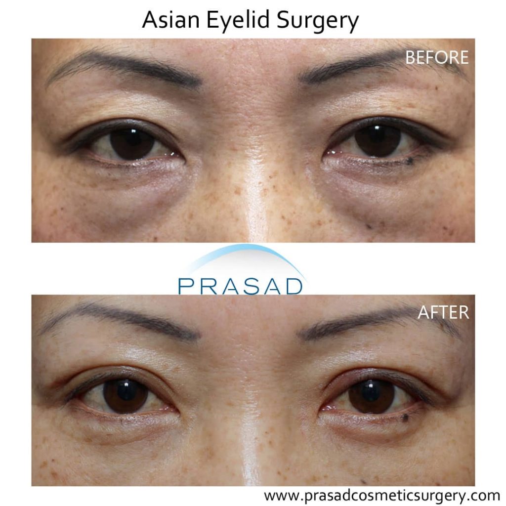 asian double eyelid surgery before and after female