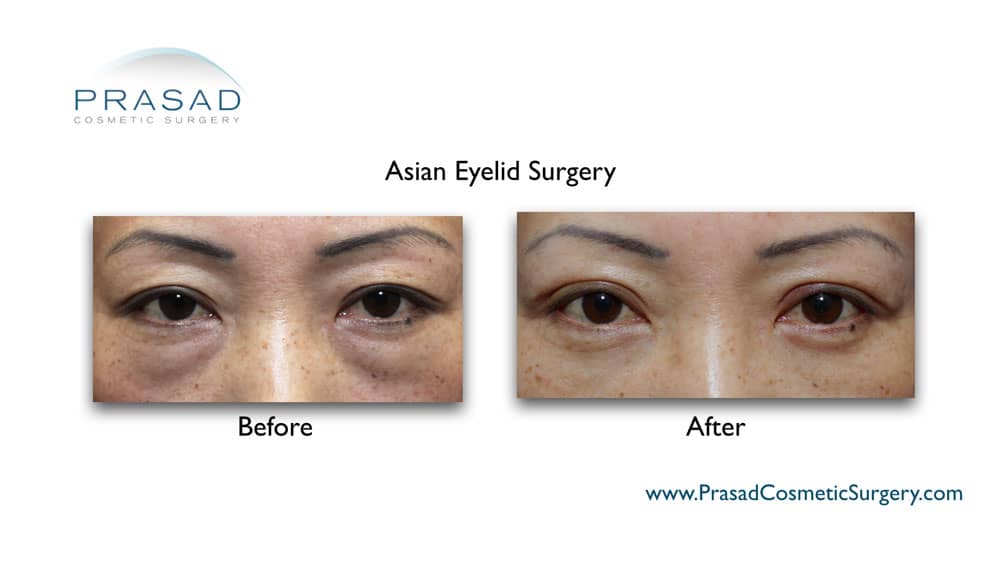 double eyelid surgery before and after
