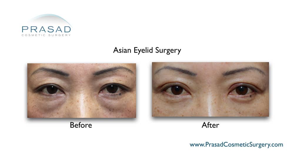 Asian double eyelid surgery on sale recovery