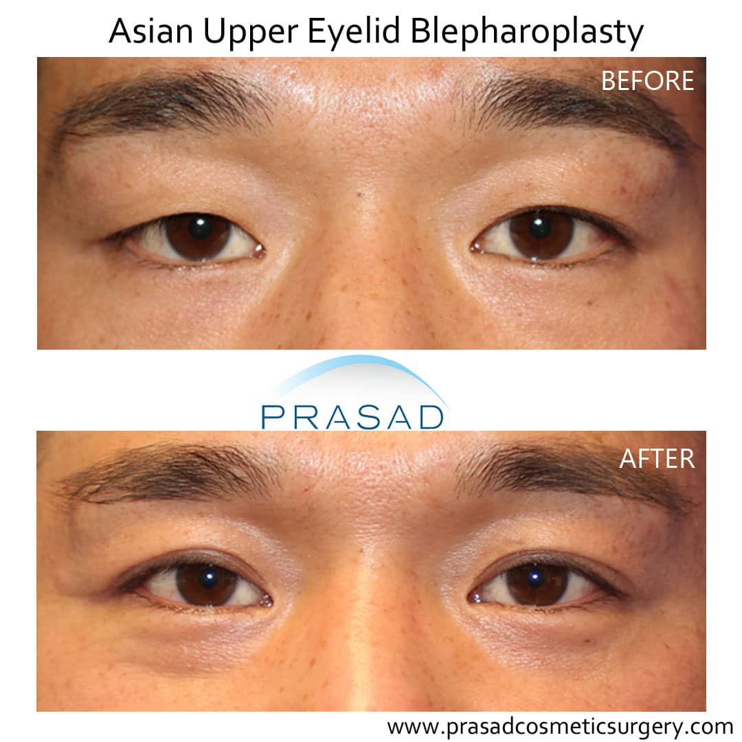 Asian eyelid surgery before and after results of young male patient