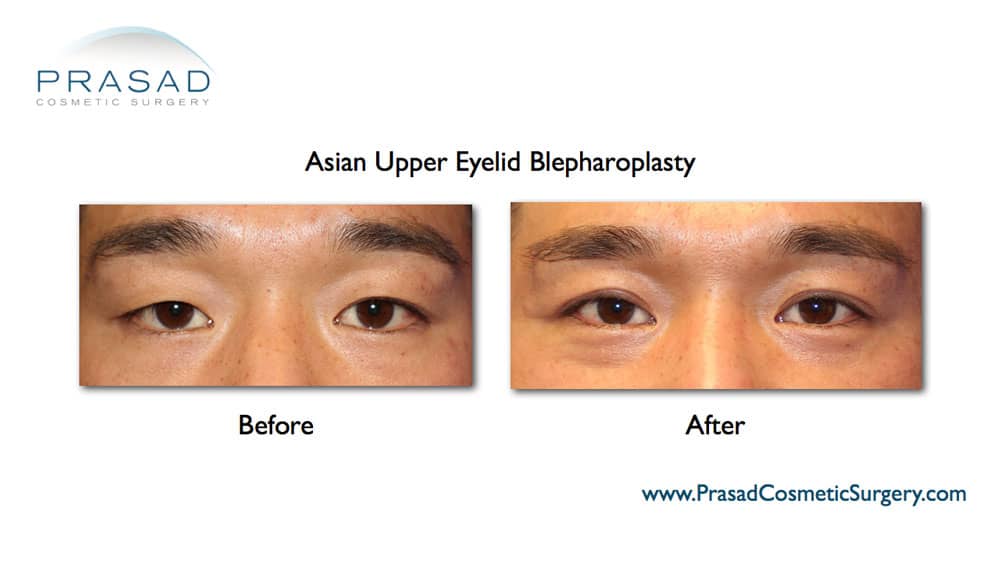 before and after double eyelid surgery male