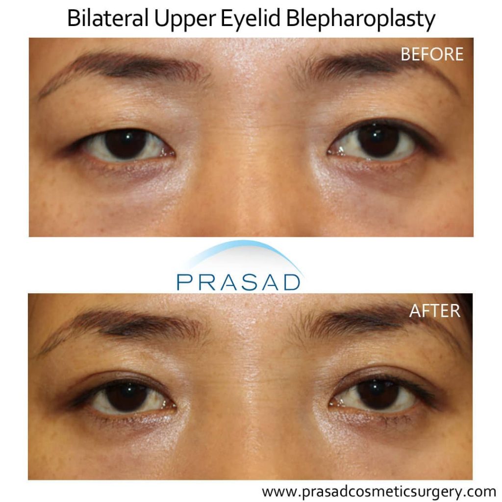 Asian eyelid surgery Upper blepharoplasty before and after