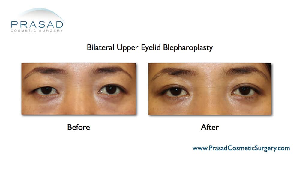 Asian eyelid surgery Upper blepharoplasty before and after