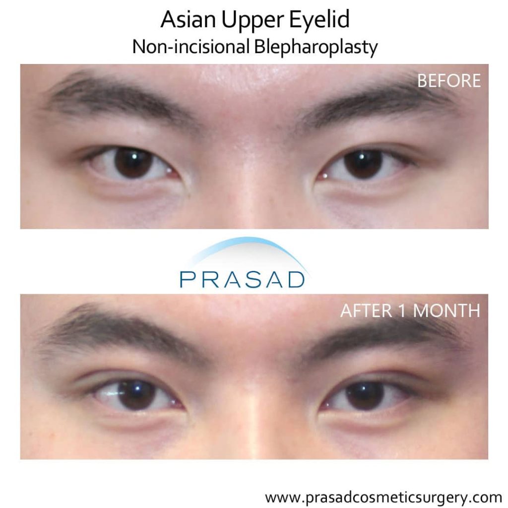 Double eyelid surgery recovery after 1 month - Asian male
