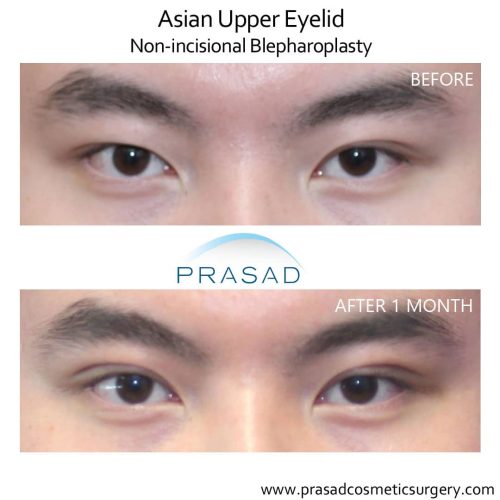 Uneven Eyes: When Treatment Is Needed? | Dr. Prasad Blog