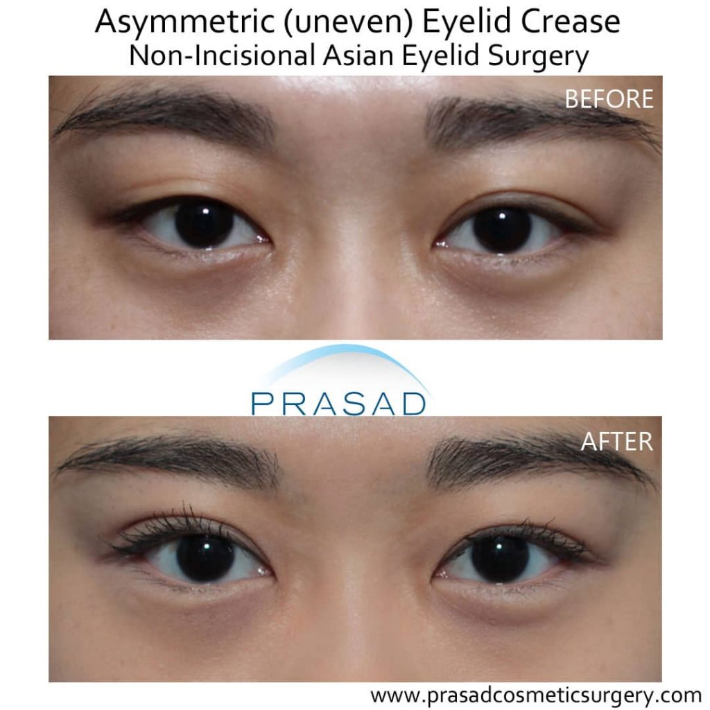 Uneven eyelid crease Asian blepharoplasty before and after