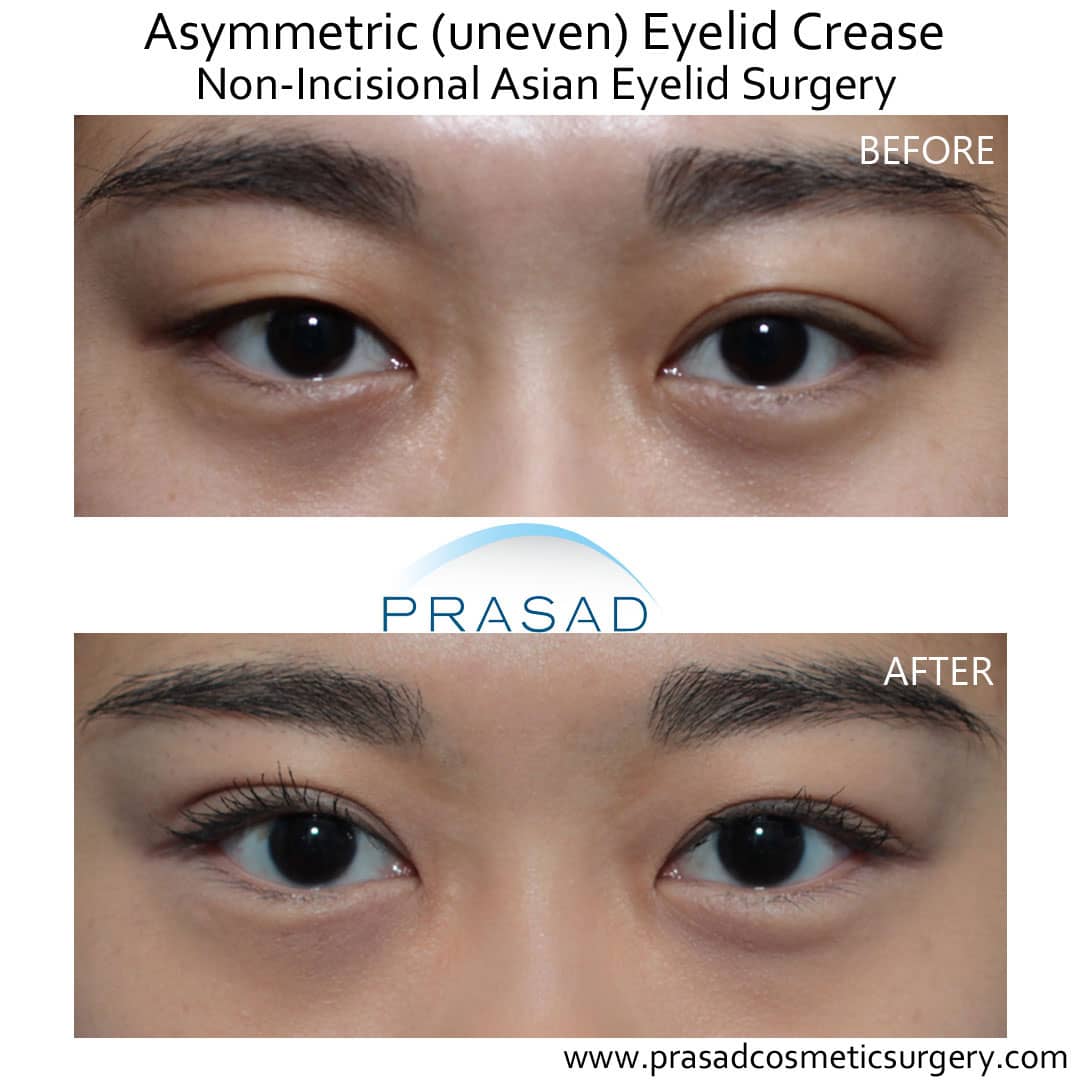 Uneven eyelid crease Asian blepharoplasty before and after