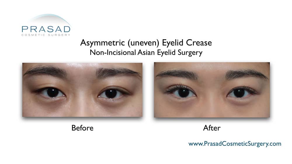 Double eyelid plastic before and after
