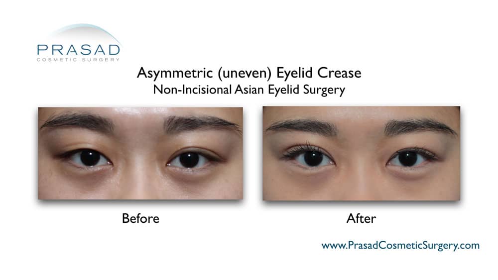 Uneven double clearance eyelid