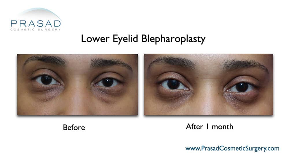 lower blepharoplasty before and after 1 month young female patient