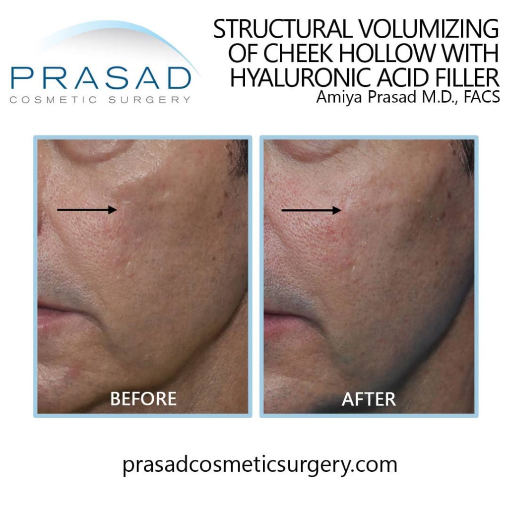 chin filler before and after procedure done by Dr. Prasad NYC office