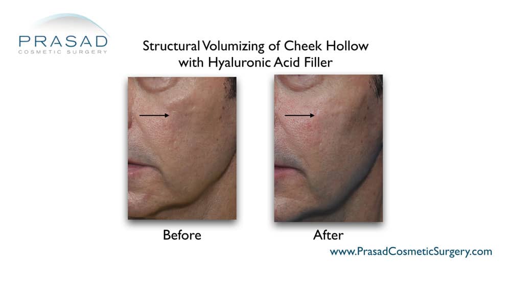 chin filler before and after