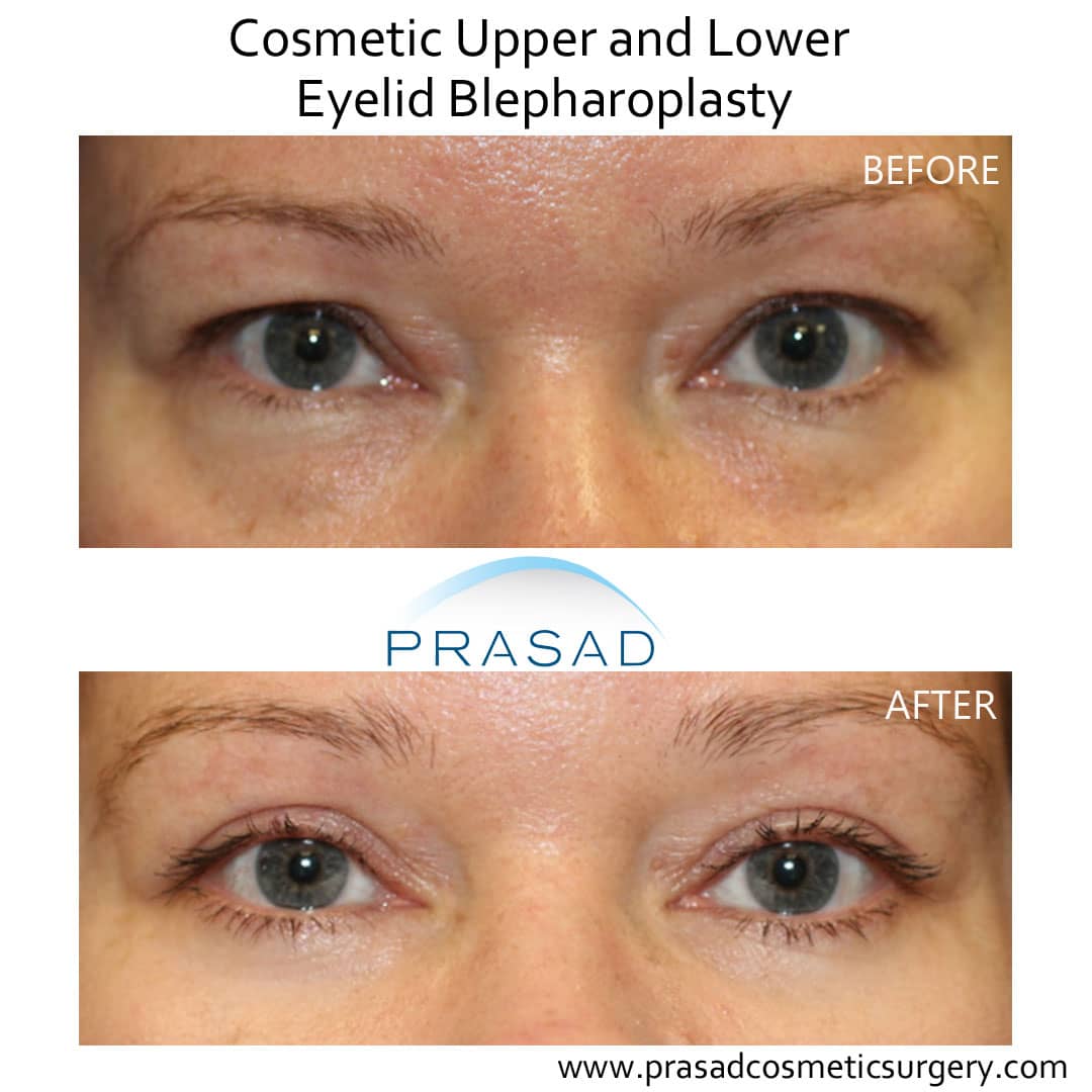 cosmetic upper and lower eyelid blepharoplasty healing eyes before and after