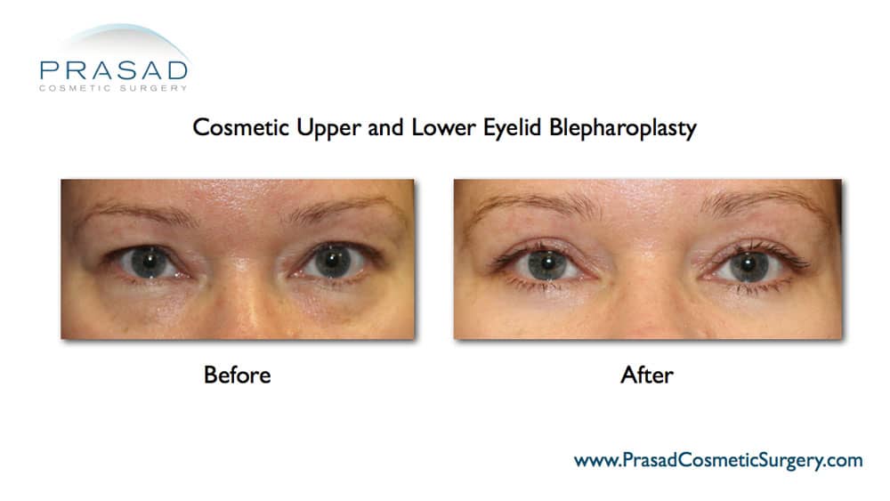 upper and lower blepharoplasty complete recovery before and after