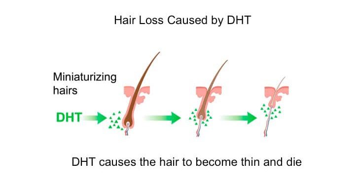 DHT causing hair to thin. hair thinning vs hair shedding