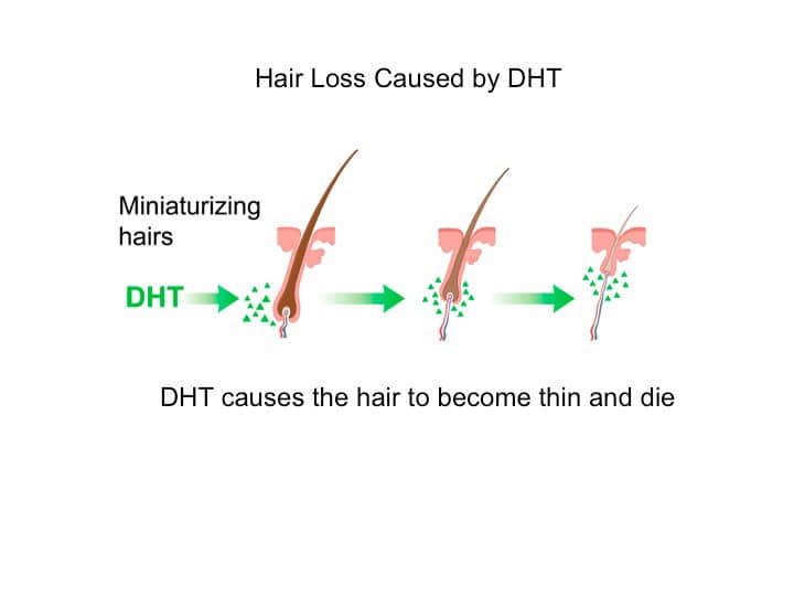 DHT causing hair to thin. hair thinning vs hair shedding