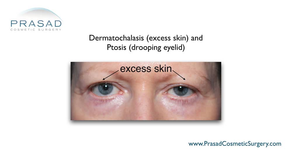 patient with dermatochalasis and ptosis