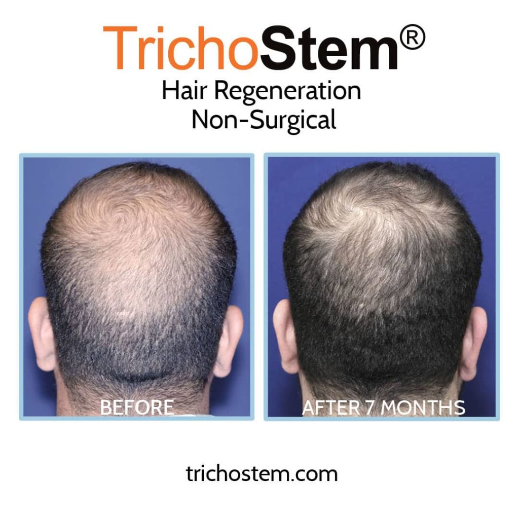 Hair transplant growth stages week by week and month by month [Progress]