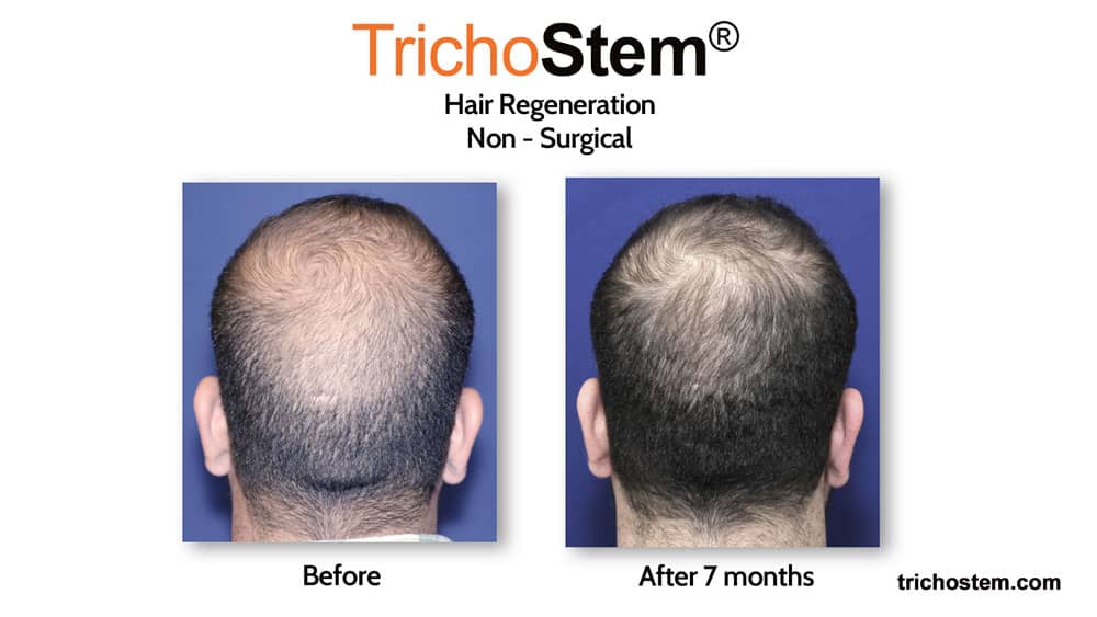 hair regeneration results before and after 7 months