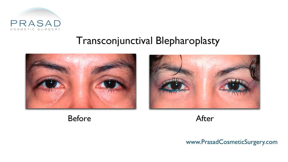 lower eyelid blepharoplasty before and after photo
