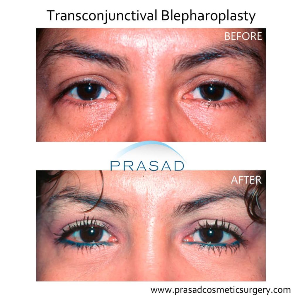 lower blepharoplasty before and after female patient