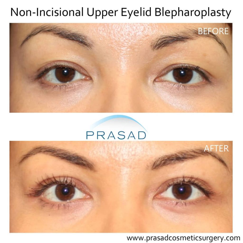 Non incisional double eyelid surgery before and after