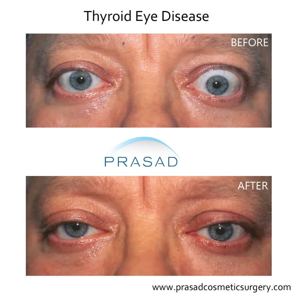 thyroid eye disease before and after recovery photo
