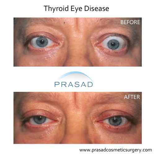 Thyroid Eye Disease Surgery/ Graves Eye Disease Surgery