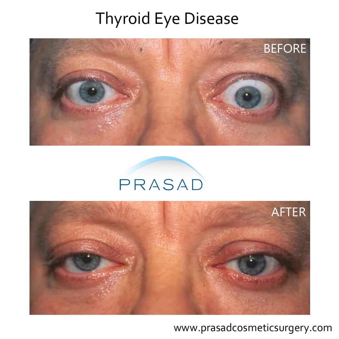 Thyroid Eye Disease Surgery Graves Eye Disease Surgery