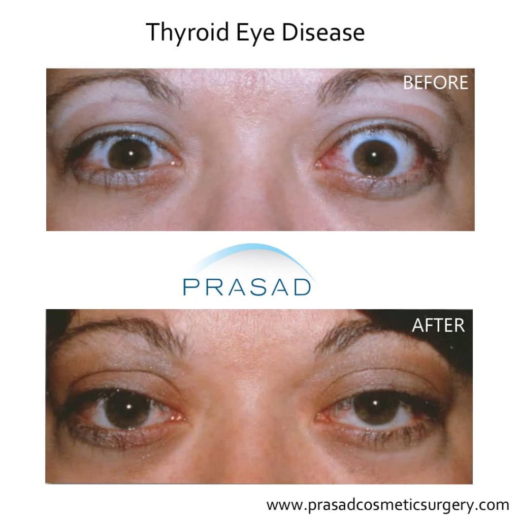 Thyroid Eye Disease Before and After