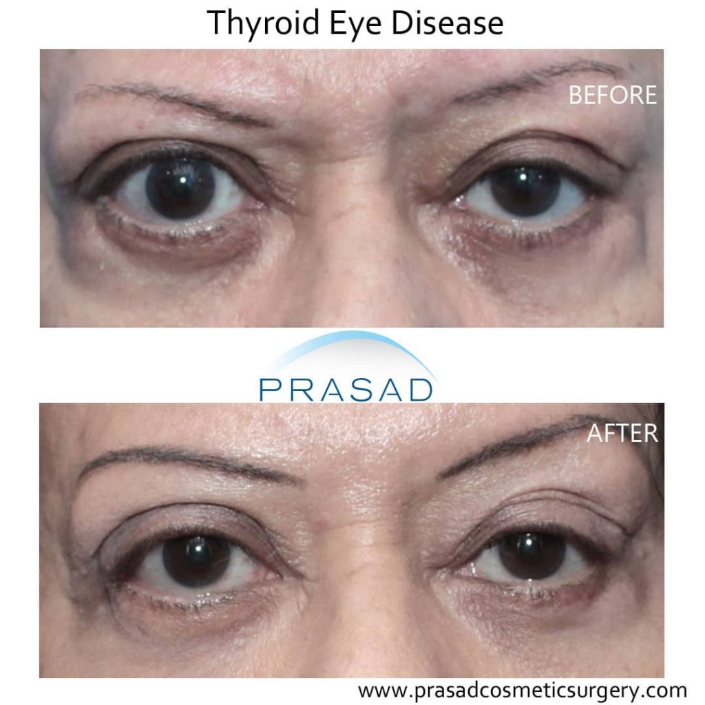 treatment for thyroid eye disease before and after