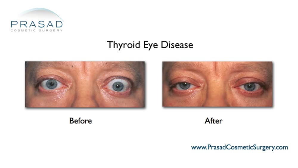thyroid eye disease treatment before and after