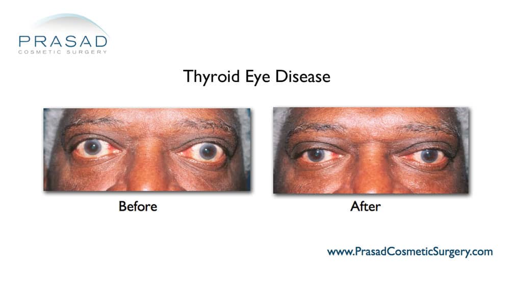 thyroid eye disease surgery performed by Dr. Amiya Prasad before and after