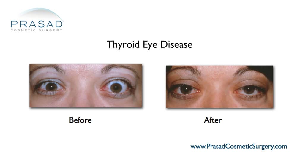 thyroid eye disease before and after picture