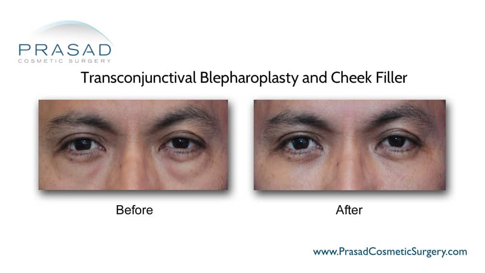 under eye bag surgery and cheek fillers before and after