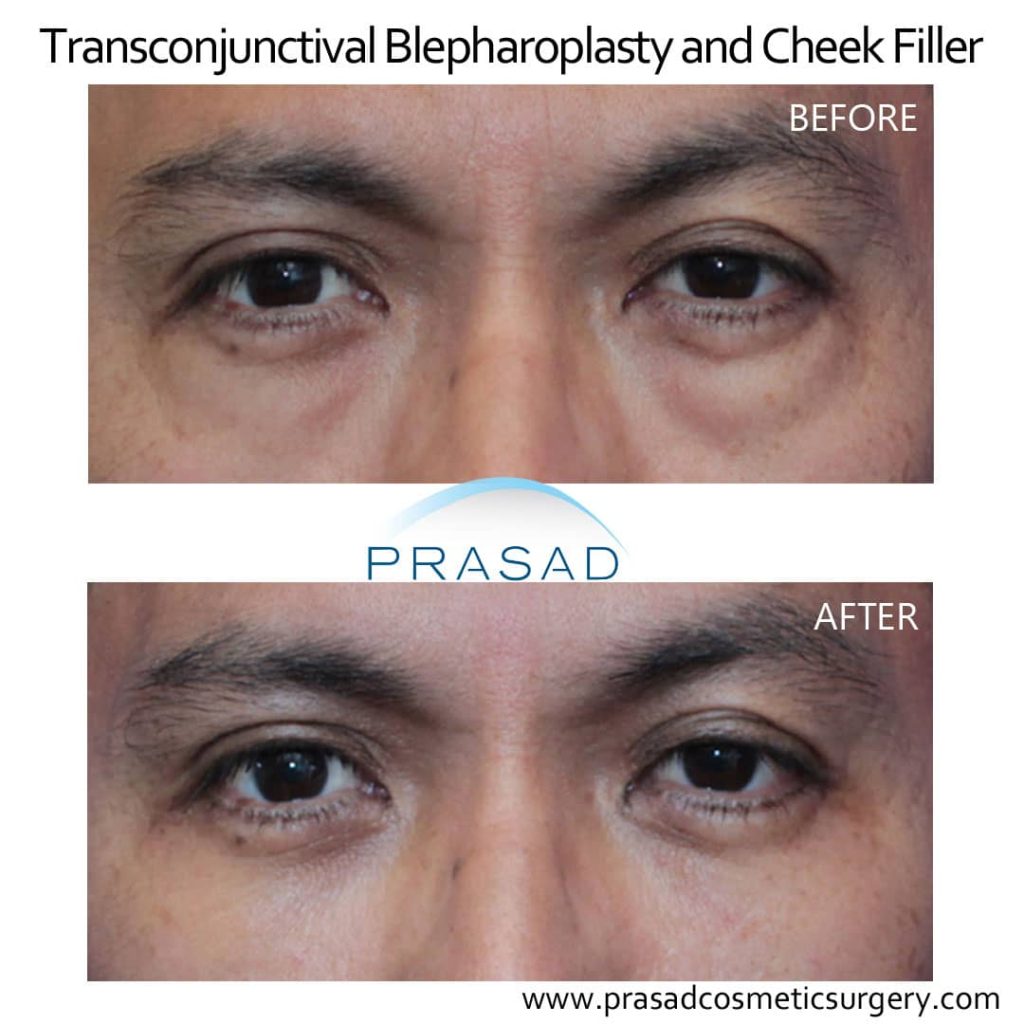 lower eyelid blepharoplasty and cheek fillers before and after