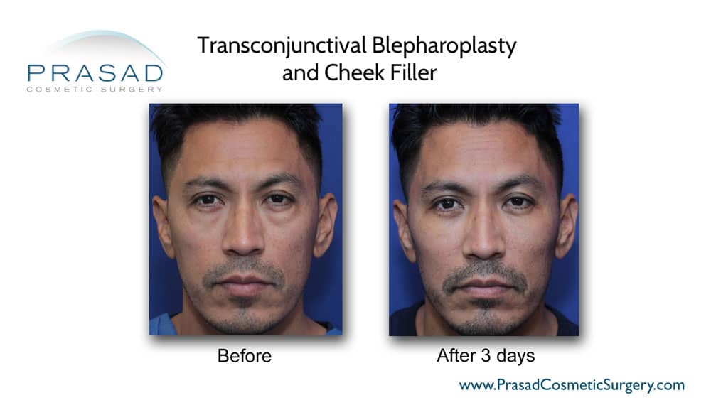 lower blepharoplasty and cheek filler before and after 3 days recovery