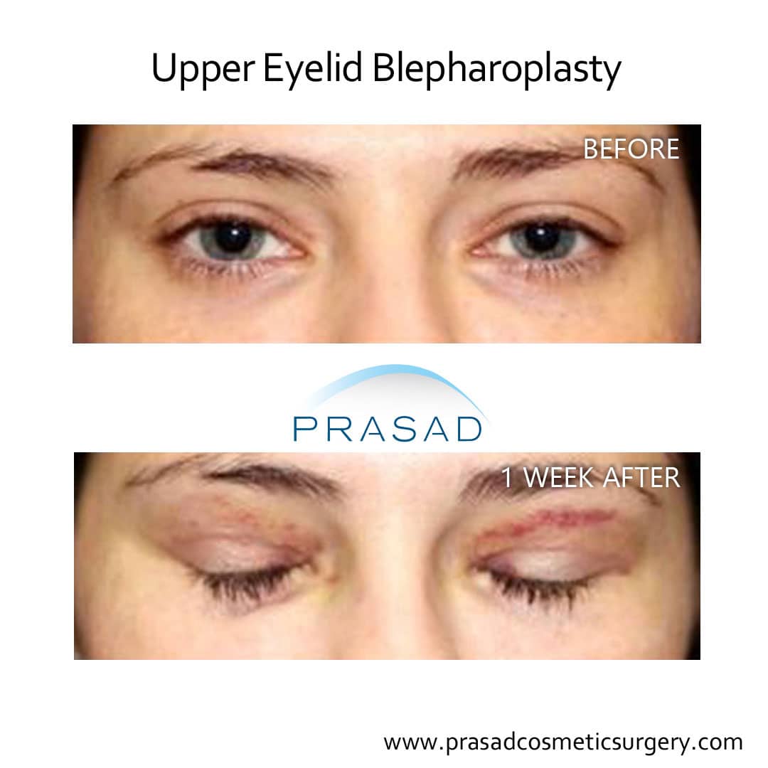 before and 1 week after upper eyelid blepharoplasty
