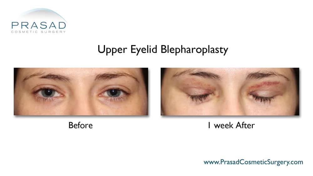 before and I week after upper eyelid surgery