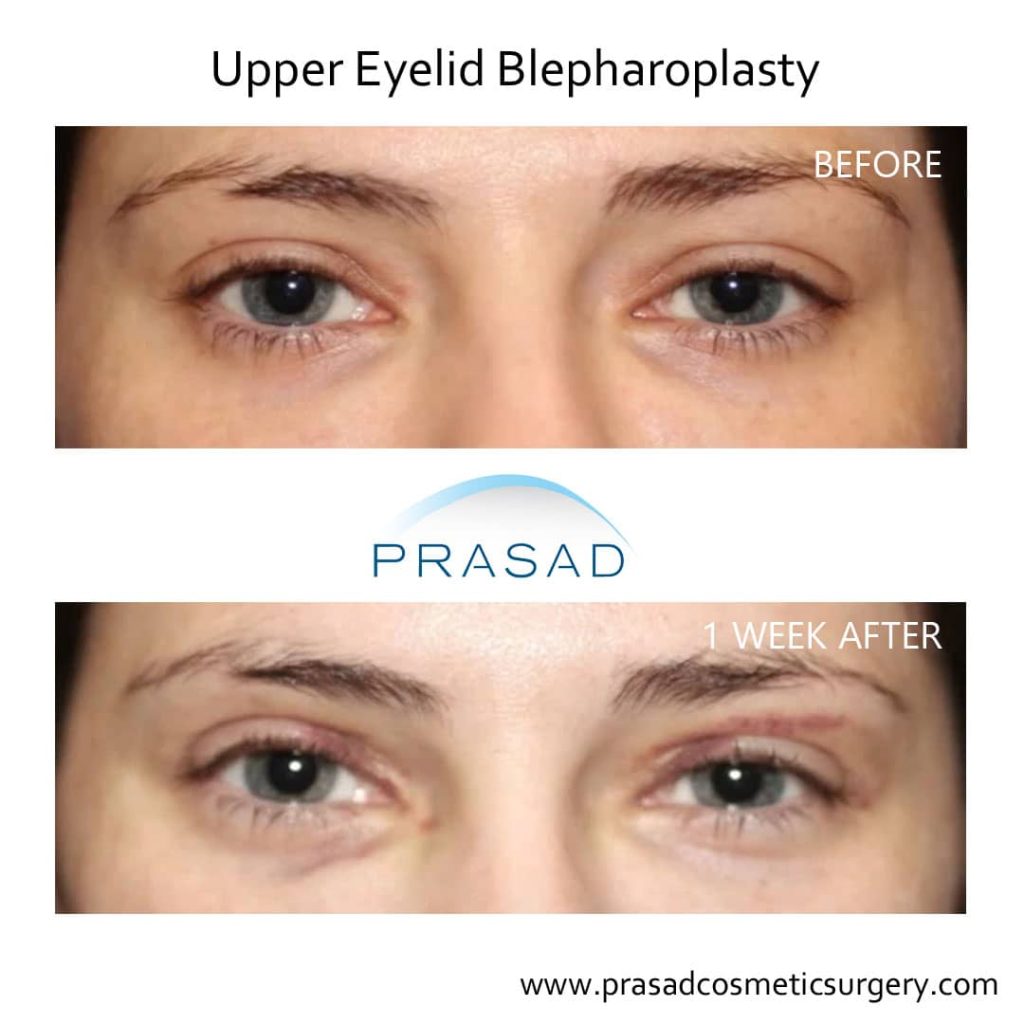 Upper eyelid blepharoplasty before and after 1 week recovery
